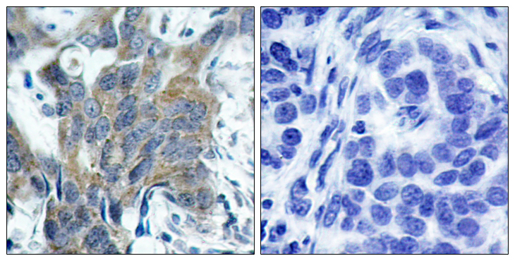 CTNNB1 / Beta Catenin Antibody - Immunohistochemistry analysis of paraffin-embedded human breast carcinoma, using Catenin-beta (Phospho-Ser33) Antibody. The picture on the right is blocked with the phospho peptide.