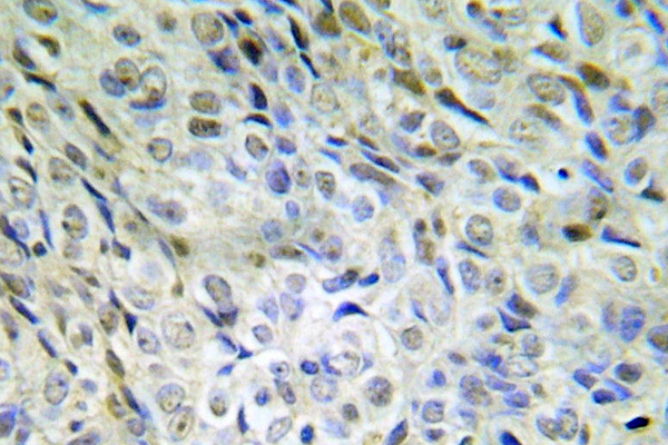 CTNNB1 / Beta Catenin Antibody - IHC of p-beta-catenin (S33/S37/T41) pAb in paraffin-embedded human lung adenocarcinoma tissue.
