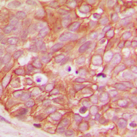 CTNNB1 / Beta Catenin Antibody - Immunohistochemical analysis of Beta-catenin (pS33) staining in human breast cancer formalin fixed paraffin embedded tissue section. The section was pre-treated using heat mediated antigen retrieval with sodium citrate buffer (pH 6.0). The section was then incubated with the antibody at room temperature and detected using an HRP conjugated compact polymer system. DAB was used as the chromogen. The section was then counterstained with hematoxylin and mounted with DPX.