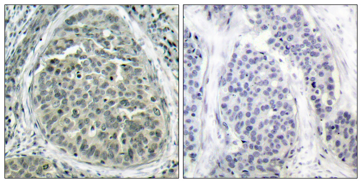 CTNNB1 / Beta Catenin Antibody - Immunohistochemistry analysis of paraffin-embedded human breast carcinoma, using Catenin-beta (Phospho-Ser37) Antibody. The picture on the right is blocked with the phospho peptide.