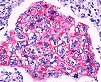 CTNNB1 / Beta Catenin Antibody - Formalin/paraffin breast ductal carcinoma stained with beta-Catenin antibody. Note membrane staining in ductal carcinoma.  This image was taken for the unmodified form of this product. Other forms have not been tested.