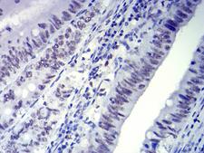 CTNNBL1 / NAP Antibody - Immunohistochemical analysis of paraffin-embedded rectum cancer tissues using CTNNBL1 mouse mAb with DAB staining.