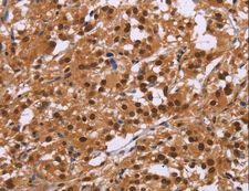 CTNNBL1 / NAP Antibody - Immunohistochemistry of paraffin-embedded Human ovarian cancer using CTNNBL1 Polyclonal Antibody at dilution of 1:50.