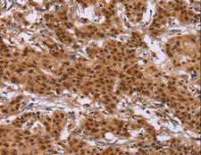 CTNNBL1 / NAP Antibody - Immunohistochemistry of paraffin-embedded Human liver cancer using CTNNBL1 Polyclonal Antibody at dilution of 1:50.