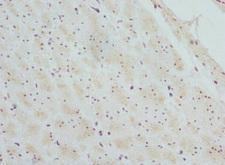CTNNBL1 / NAP Antibody - Immunohistochemistry of paraffin-embedded Human colon cancer at dilution 1:100