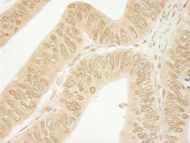 CTNND1 / p120 Catenin Antibody - Detection of Human CTNND1 by Immunohistochemistry. Sample: FFPE section of human colon carcinoma. Antibody: Affinity purified rabbit anti-CTNND1 used at a dilution of 1:1000 (1 ug/ml). Detection: DAB.