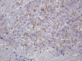 CTNND1 / p120 Catenin Antibody - IHC of paraffin-embedded Adenocarcinoma of Human colon tissue using anti-CTNND1 mouse monoclonal antibody. (Heat-induced epitope retrieval by 10mM citric buffer, pH6.0, 120°C for 3min).