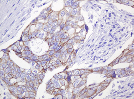 CTNND1 / p120 Catenin Antibody - IHC of paraffin-embedded Adenocarcinoma of Human breast tissue using anti-CTNND1 mouse monoclonal antibody. (Heat-induced epitope retrieval by 10mM citric buffer, pH6.0, 120°C for 3min).