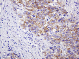 CTNND1 / p120 Catenin Antibody - IHC of paraffin-embedded Adenocarcinoma of Human colon tissue using anti-CTNND1 mouse monoclonal antibody. (Heat-induced epitope retrieval by 10mM citric buffer, pH6.0, 120°C for 3min).