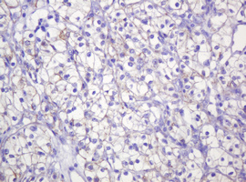 CTNND1 / p120 Catenin Antibody - IHC of paraffin-embedded Carcinoma of Human kidney tissue using anti-CTNND1 mouse monoclonal antibody. (Heat-induced epitope retrieval by 10mM citric buffer, pH6.0, 120°C for 3min).
