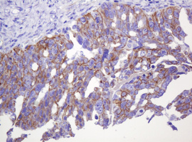 CTNND1 / p120 Catenin Antibody - IHC of paraffin-embedded Adenocarcinoma of Human ovary tissue using anti-CTNND1 mouse monoclonal antibody. (Heat-induced epitope retrieval by 10mM citric buffer, pH6.0, 120°C for 3min).