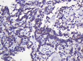 CTNND1 / p120 Catenin Antibody - IHC of paraffin-embedded Carcinoma of Human pancreas tissue using anti-CTNND1 mouse monoclonal antibody. (Heat-induced epitope retrieval by 10mM citric buffer, pH6.0, 120°C for 3min).