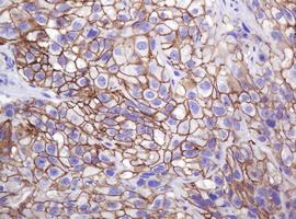 CTNND1 / p120 Catenin Antibody - IHC of paraffin-embedded Carcinoma of Human bladder tissue using anti-CTNND1 mouse monoclonal antibody. (Heat-induced epitope retrieval by 10mM citric buffer, pH6.0, 120°C for 3min).