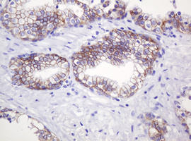 CTNND1 / p120 Catenin Antibody - IHC of paraffin-embedded Carcinoma of Human prostate tissue using anti-CTNND1 mouse monoclonal antibody. (Heat-induced epitope retrieval by 10mM citric buffer, pH6.0, 120°C for 3min).