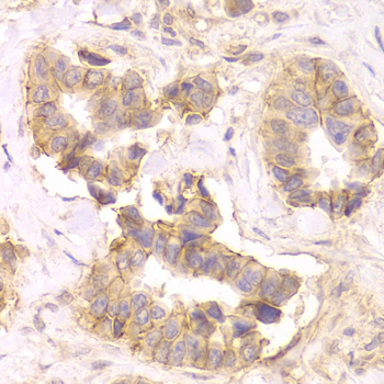 CTNND1 / p120 Catenin Antibody - Immunohistochemistry of paraffin-embedded Human mammary cancer tissue.