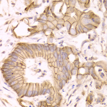 CTNND1 / p120 Catenin Antibody - Immunohistochemistry of paraffin-embedded liver cancer tissue.