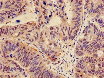 CTNND1 / p120 Catenin Antibody - Immunohistochemistry image of paraffin-embedded human colon cancer at a dilution of 1:100