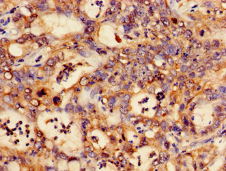 CTNND1 / p120 Catenin Antibody - Immunohistochemistry image of paraffin-embedded human liver cancer at a dilution of 1:100