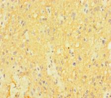 CTNND2 / Delta-2 Catenin Antibody - Immunohistochemistry of paraffin-embedded human glioma cancer at dilution of 1:100