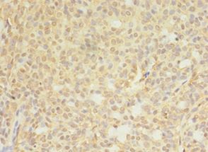 CTPS Antibody - Immunohistochemistry of paraffin-embedded human breast cancer tissue using antibody at 1: 100 dilution.  This image was taken for the unconjugated form of this product. Other forms have not been tested.