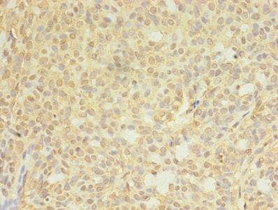 CTPS Antibody - Immunohistochemistry of paraffin-embedded human breast cancer using CTPS1 Antibody at dilution of 1:100