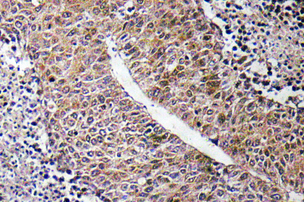 CTPS Antibody - IHC of CTPS (K109 pAb in paraffin-embedded human liver carcinoma tissue.