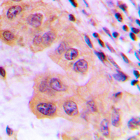 CTPS Antibody - Immunohistochemical analysis of CTPS staining in human liver cancer formalin fixed paraffin embedded tissue section. The section was pre-treated using heat mediated antigen retrieval with sodium citrate buffer (pH 6.0). The section was then incubated with the antibody at room temperature and detected using an HRP conjugated compact polymer system. DAB was used as the chromogen. The section was then counterstained with hematoxylin and mounted with DPX.