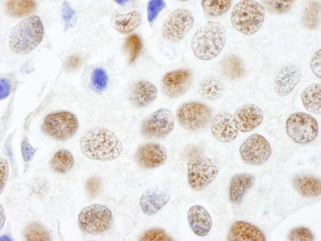CTR9 Antibody - Detection of Human CTR9 by Immunohistochemistry. Sample: FFPE section of human breast carcinoma. Antibody: Affinity purified rabbit anti-CTR9 used at a dilution of 1:250.