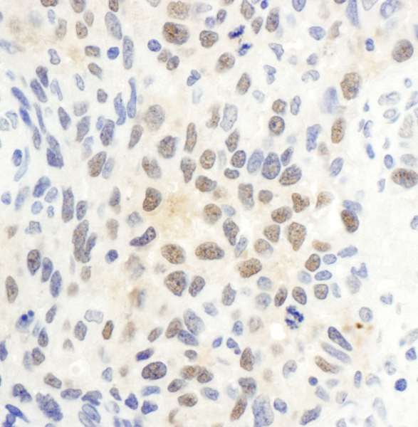 CTR9 Antibody - Detection of Human CTR9 by Immunohistochemistry. Sample: FFPE section of human ovarian carcinoma. Antibody: Affinity purified rabbit anti-CTR9 used at a dilution of 1:1000 (1 ug/ml). Detection: DAB.