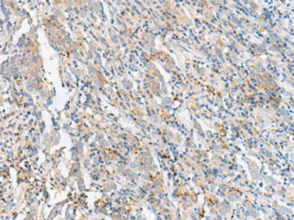 CTRB1 / Chymotrypsinogen B1 Antibody - Immunohistochemistry of paraffin-embedded Human cervical cancer tissue  using CTRB1 Polyclonal Antibody at dilution of 1:60(×200)