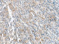 CTRB1 / Chymotrypsinogen B1 Antibody - Immunohistochemistry of paraffin-embedded Human cervical cancer tissue  using CTRB1 Polyclonal Antibody at dilution of 1:60(×200)