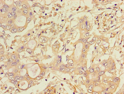 CTSA / Cathepsin A Antibody - Immunohistochemistry of paraffin-embedded human pancreatic cancer using CTSA Antibody at dilution of 1:100