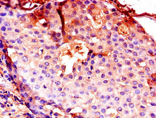 CTSB / Cathepsin B Antibody - Immunohistochemistry of paraffin-embedded human breast cancer using CTSB Antibody at dilution of 1:100