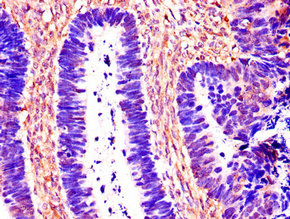 CTSB / Cathepsin B Antibody - Immunohistochemistry of paraffin-embedded human ovarian cancer using CTSB Antibody at dilution of 1:100