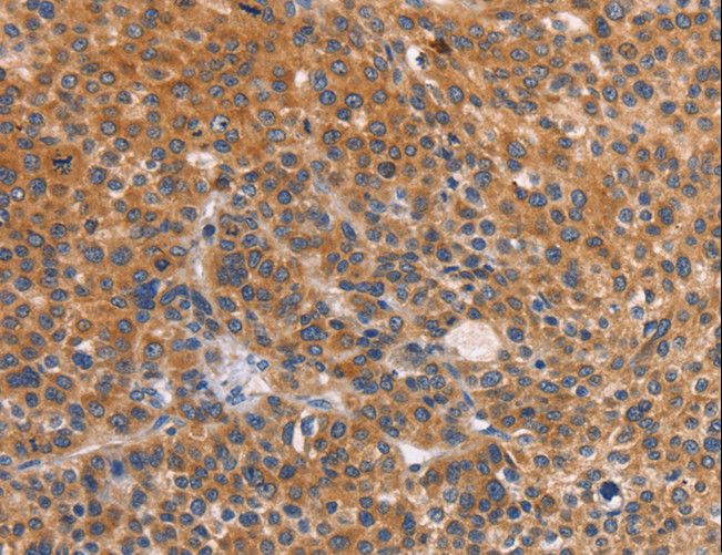 CTSC / Cathepsin C / JP Antibody - Immunohistochemistry of paraffin-embedded Human liver cancer using CTSC Polyclonal Antibody at dilution of 1:50.