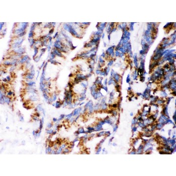 CTSD / Cathepsin D Antibody - Cathepsin D was detected in paraffin-embedded sections of human Intestinal cancer tissues using rabbit anti- Cathepsin D Antigen Affinity purified polyclonal antibody at 1 ug/mL. The immunohistochemical section was developed using SABC method.