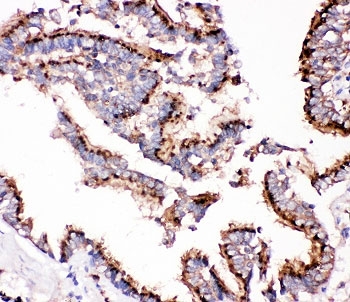CTSD / Cathepsin D Antibody - IHC-P: Cathepsin D antibody testing of human lung cancer tissue