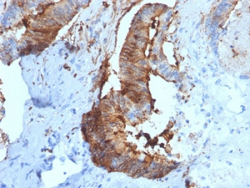 CTSD / Cathepsin D Antibody - IHC testing of FFPE human renal cell carcinoma with Cathepsin D antibody (clone CTSD/2781). HIER: boil tissue sections in pH6, 10mM citrate buffer, for 10-20 min followed by cooling at RT for 20 min.