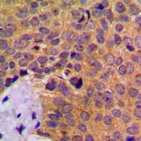 CTSD / Cathepsin D Antibody - Immunohistochemical analysis of Cathepsin D staining in human breast cancer formalin fixed paraffin embedded tissue section. The section was pre-treated using heat mediated antigen retrieval with sodium citrate buffer (pH 6.0). The section was then incubated with the antibody at room temperature and detected with HRP and DAB as chromogen. The section was then counterstained with hematoxylin and mounted with DPX.