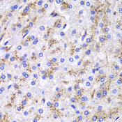CTSD / Cathepsin D Antibody - Immunohistochemistry of paraffin-embedded human liver cancer tissue.