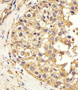 CTSD / Cathepsin D Antibody - Immunohistochemical of paraffin-embedded H.breast carcinoma section using CTSD. Antibody was diluted at 1:25 dilution. A peroxidase-conjugated goat anti-rabbit IgG at 1:400 dilution was used as the secondary antibody, followed by DAB staining.