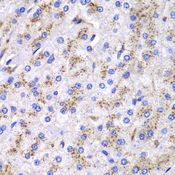 CTSD / Cathepsin D Antibody - Immunohistochemistry of paraffin-embedded human liver cancer using CTSD antibody at dilution of 1:100 (40x lens).