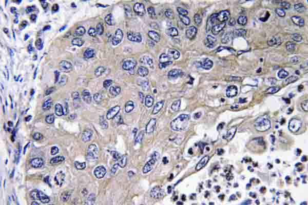 CTSD / Cathepsin D Antibody - IHC of Cathepsin D (K345) pAb in paraffin-embedded human lung carcinoma tissue.