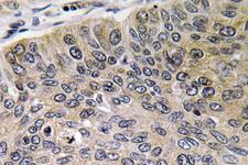 CTSE / Cathepsin E Antibody - Immunohistochemistry analysis of CathepsinÂ E antibody in paraffin-embedded human lung carcinoma tissue.