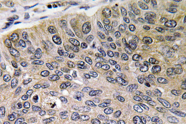 CTSE / Cathepsin E Antibody - IHC of Cathepsin E (I292) pAb in paraffin-embedded human lung carcinoma tissue.
