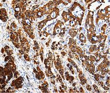 CTSE / Cathepsin E Antibody - Immunohistochemistry of paraffin-embedded human pancreatic cancer tissue using CTSE antibody.