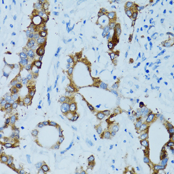 CTSE / Cathepsin E Antibody - Immunohistochemistry of paraffin-embedded human colon carcinoma tissue.