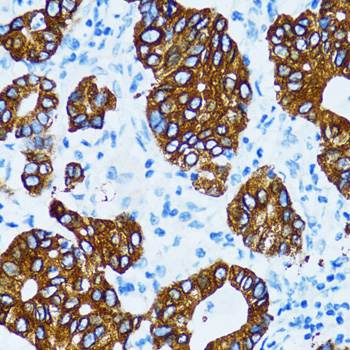 CTSE / Cathepsin E Antibody - Immunohistochemistry of paraffin-embedded human gastric cancer tissue.