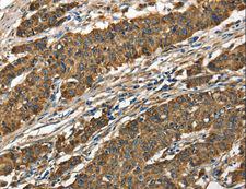 CTSE / Cathepsin E Antibody - Immunohistochemistry of paraffin-embedded Human gastric cancer using CTSE Polyclonal Antibody at dilution of 1:40.