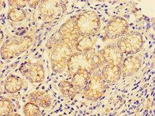 CTSE / Cathepsin E Antibody - Immunohistochemistry of paraffin-embedded human gastric cancer using CTSE Antibody at dilution of 1:100